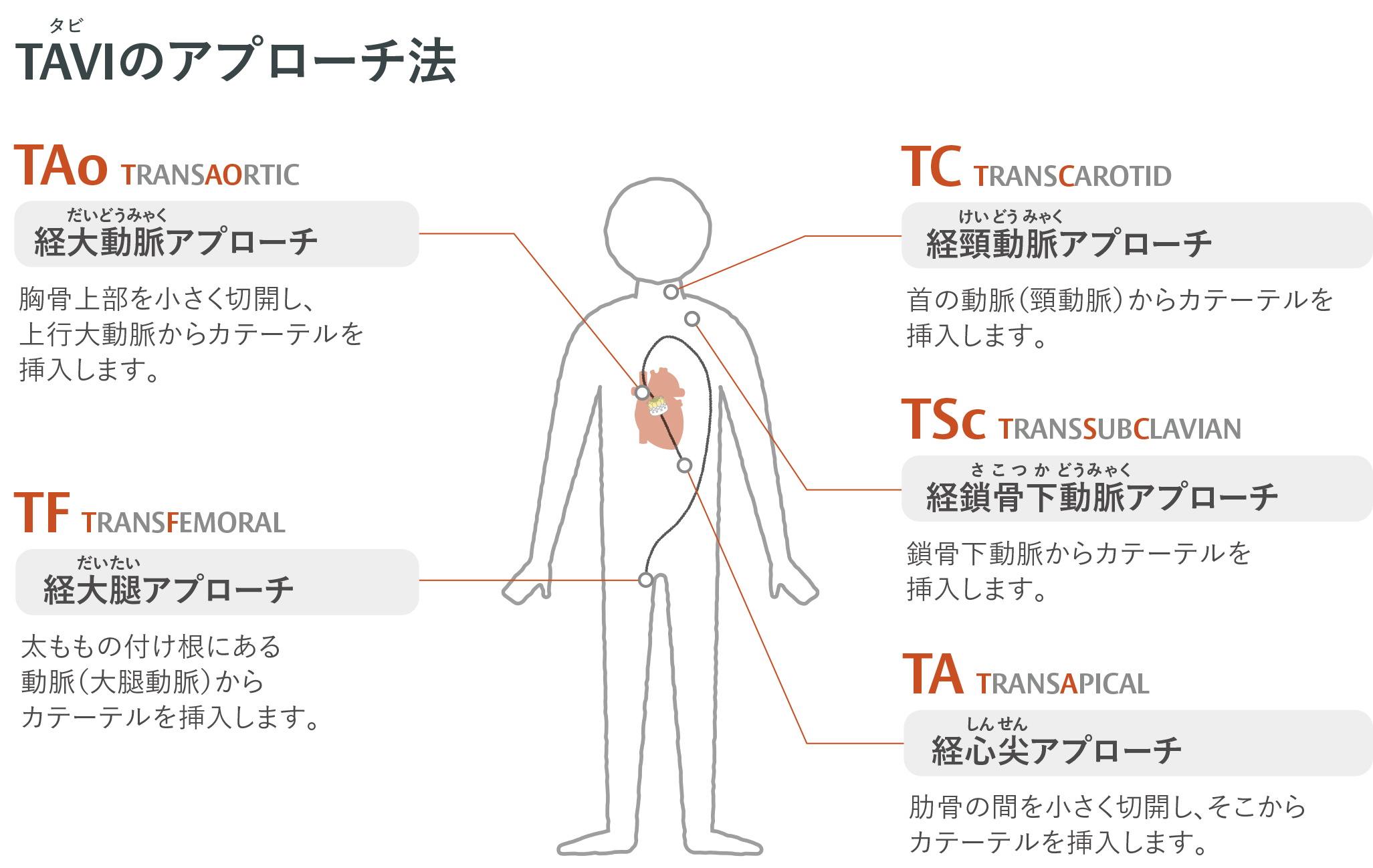 TAVIアプローチ方法